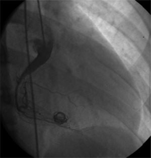 Final angiogram showing complete occlusion of the fistula. Note improvement in myocardial perfusion following embolization of the fistula.