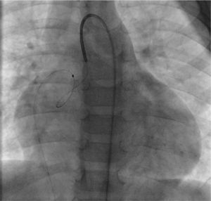 Formation of an arteriovenous loop through the coronary fistula.