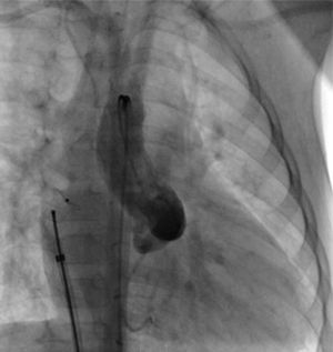 Final contrast injection following closure of the fistula with an Amplatzer® duct occluder in the right atrium, showing absence of residual flow.