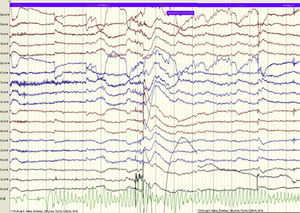 Polymorphic ventricular tachycardia recorded on single-lead ECG during video EEG.