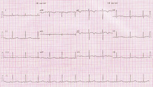 ECG trace with QTc of 482ms.
