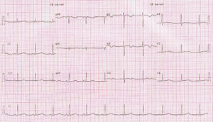 ECG trace with QTc of 482ms.
