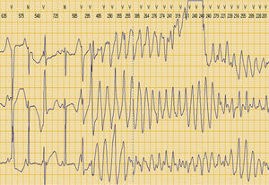 Polymorphic ventricular tachycardia (torsade de pointes) recorded on Holter 24-hour monitoring.