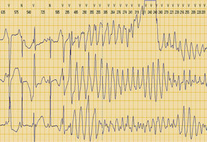Polymorphic ventricular tachycardia (torsade de pointes) recorded on Holter 24-hour monitoring.