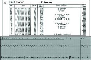 ICD record showing several episodes of ventricular fibrillation and 19 appropriate therapies (13 shocks and six episodes of antitachycardia pacing); electrogram showing ventricular fibrillation with successful defibrillation after a 40-J shock.
