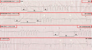 Rhythm strip with DII-like morphology, of about 30s, showing a “short (a)–long (b)–short (a)” sequence as the factor triggering unsustained VT. The red rectangles indicate that the lower strip is the continuation of the upper strip. (For interpretation of the reference to color in this figure legend, the reader is referred to the web version of the article.)