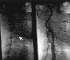A: right internal carotid artery with PRECISE® 7 × 30mm stent (arrow); B: angiographic result after stent placement.