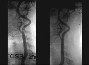A: left internal carotid artery on diagnostic angiography; B: after implantation of 6 × 30mm PRECISE® stent.