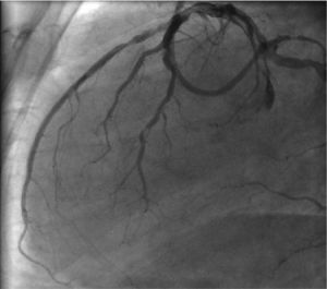 Left coronary angiography, lateral view, showing 50-70 % stenosis in the mid third of the left anterior descending artery.