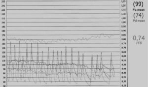 Assessment of stenosis by pressure wire following maximal hyperemia after intracoronary administration of 6cc adenosine, giving an FFR of 0.74.