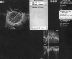 IVUS showing the final result at the critical stenosis after overdilation with a 3.5 × 15mm NC balloon.