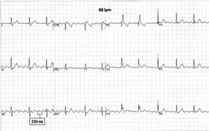 Baseline ECG.