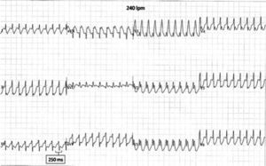 Development of 1:1 conduction during exercise.