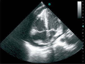Transthoracic echocardiogram (apical 4-chamber view) showing moderate pericardial effusion with collapse of the right chambers and a mass adhering to the roof of the right atrium.