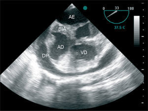 Transesophageal echocardiogram showing marked thickening of the atrial septum and right atrium. AE: Left atrium; SIA: Interatrial septum; AD: Right atrium; VD: Right ventricle; DP: Pericardial effusion.