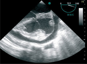Transesophageal echocardiogram showing marked thickening of the atrial septum and right atrium.