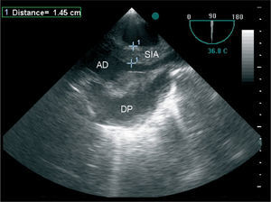 Transesophageal echocardiogram showing marked thickening of the atrial septum and right atrium. AD: Right atrium; SIA: Interatrial septum; VD: Right ventricle.