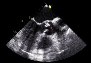 TEE showing small aortic vegetation in a supravalvular position.