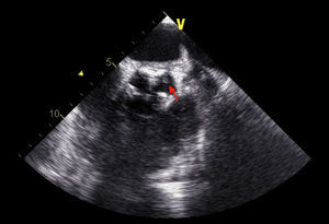 TEE of the aortic valve in short-axis view showing moderate calcification and a small vegetation attached to the left coronary cusp.