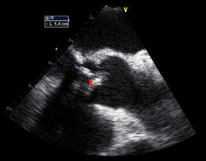TEE showing increased size of mitral vegetation.
