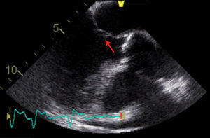 TEE showing marked decrease in size of mitral vegetation.