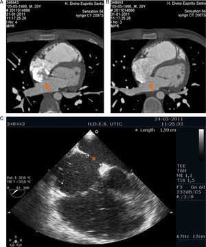 Ostium secundum-type atrial septal defect (A and B – cardiac CT; C – transesophageal echocardiogram). A: passage of contrast from left to right atrium (arrow). B: communication between left and right atria (arrow).