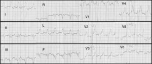 Initial electrocardiogram showing right ventricular pacing with QRS of 180ms and atrioventricular dyssynchrony.