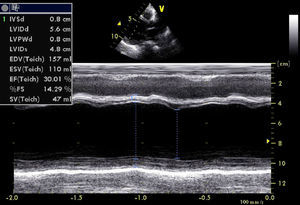 M-mode echocardiography showing left ventricular dilatation with septal flash.