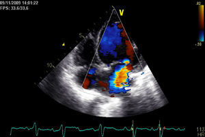Moderate to severe functional mitral regurgitation.