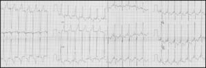 Electrocardiogram showing biventricular pacing and QRS of 120ms.