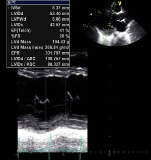 Persistence of left ventricular dilatation but improved shortening fraction and synchronous septal motion.