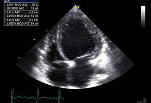 Increased ejection fraction (38%).