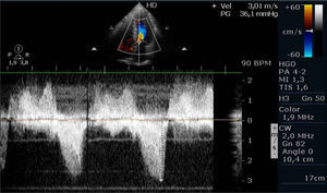 Maximum intraventricular gradient at peak exercise of 36mmHg, under therapy.