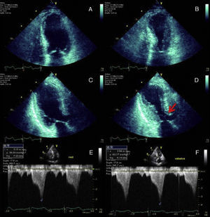 End-diastolic and end-systolic apical four-chamber (A and B) and three-chamber (C and D) echocardiographic views demonstrating the typical apical and mid-ventricular LV wall-motion abnormalities that raised the suspicion of Takotsubo cardiomyopathy. SAM of the mitral valve with LVOT obstruction is signaled by the red arrow (D). Continuous-wave Doppler profile outlining the degree of LVOT obstruction at rest (E) and during the Valsalva maneuver (F).