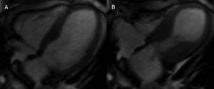 Cardiovascular magnetic resonance (CMR) in Takotsubo cardiomyopathy. End-diastolic (A) and end-systolic (B) frames from a four-chamber cine sequence demonstrate hyperdynamic function of basal segments with apical hypokinesia.