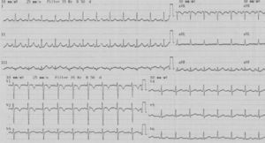 ECG showing sinus tachycardia with tall R waves in V1–V3 and T-wave inversion in V1–V2.
