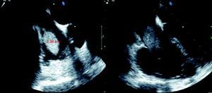 Transesophageal echocardiogram showing a multilobulated mass, apparently pedunculated, measuring around 3cm, in the right atrium.