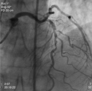 Coronary angiography showing the culprit lesion (subocclusive stenosis of the proximal LAD).