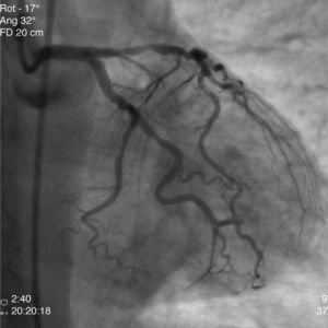Coronary angiography showing critical stenosis of the circumflex artery.