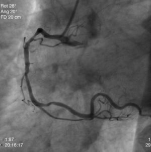 Coronary angiography showing critical stenosis of the right coronary artery.