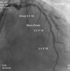 Coronary angiography after implantation of three bare-metal stents in the LAD.