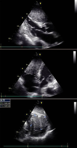 Two-dimensional transthoracic echocardiogram (top: parasternal long-axis view; middle: apical four-chamber view; bottom: subcostal view) showing involvement of the ventricular septum by the mass, which also protrudes into the right ventricular chamber. Maximum dimensions of 60mm×66mm assessed in subcostal view.