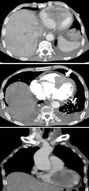 Computed tomography (top and middle: axial plane with and without contrast, respectively; bottom: coronal plane), better defining the extent of the cardiac mass as well as its relation with adjacent structures. Arrow: left anterior descending artery.