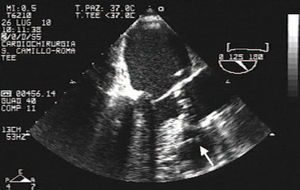 Intraoperative transesophageal echocardiography (TEE): valvuloplasty catheter impinging on the interventricular septum (white arrow).