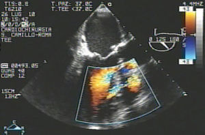 Intraoperative TEE: a clear left-to-right shunt was detected on color Doppler.