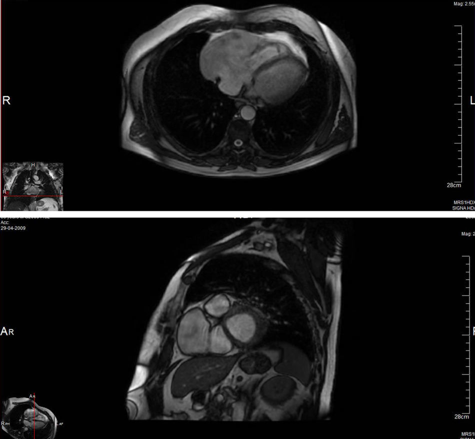 Right Atrial Rupture Right atrial aneurysm after chest trauma: Late presentation | Revista ...