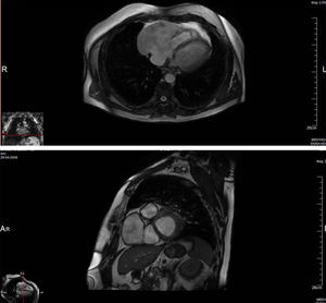 Cardiac magnetic resonance imaging (FIESTA), showing an anterior aneurysmal cavity in the right atrial free wall (11.2cm×6.6cm) in right ventricular long-axis view (top) and in transverse view (bottom).