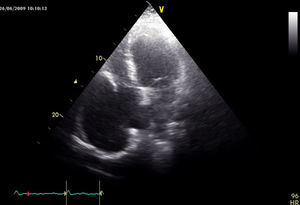 Transthoracic echocardiography in 4-chamber apical view, showing an aneurysmal cavity in the right atrial free wall (11.8cm×7cm), communicating with the atrial chamber through a 4.9cm orifice, with no apparent tricuspid valve abnormalities.