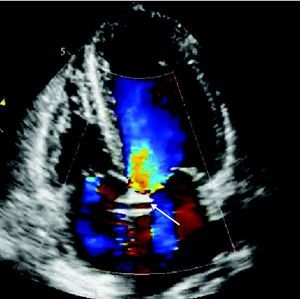 Apical 4-chamber echocardiogram with color Doppler revealing flow inside the tubular structure (arrow).
