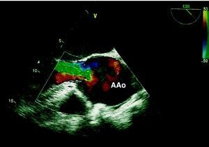 Echocardiographic image of the aortic aneurysm (AAo) with severe aortic regurgitation.